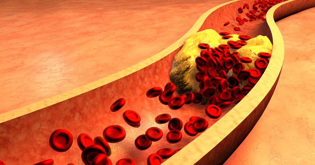 The New “Bad Cholesterol” Shortens Your Life about false
